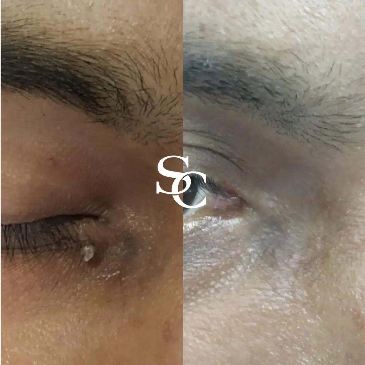 Mole Removal Client Results